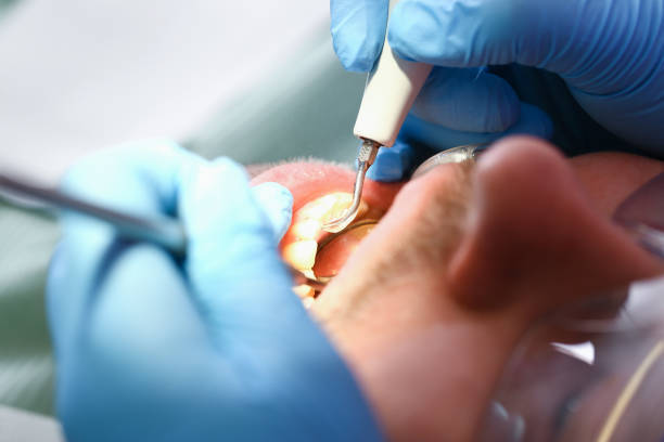Best Emergency Root Canal Treatment in Arcola, VA