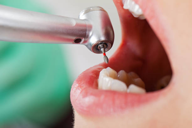 Best Emergency Tooth Extraction in Arcola, VA